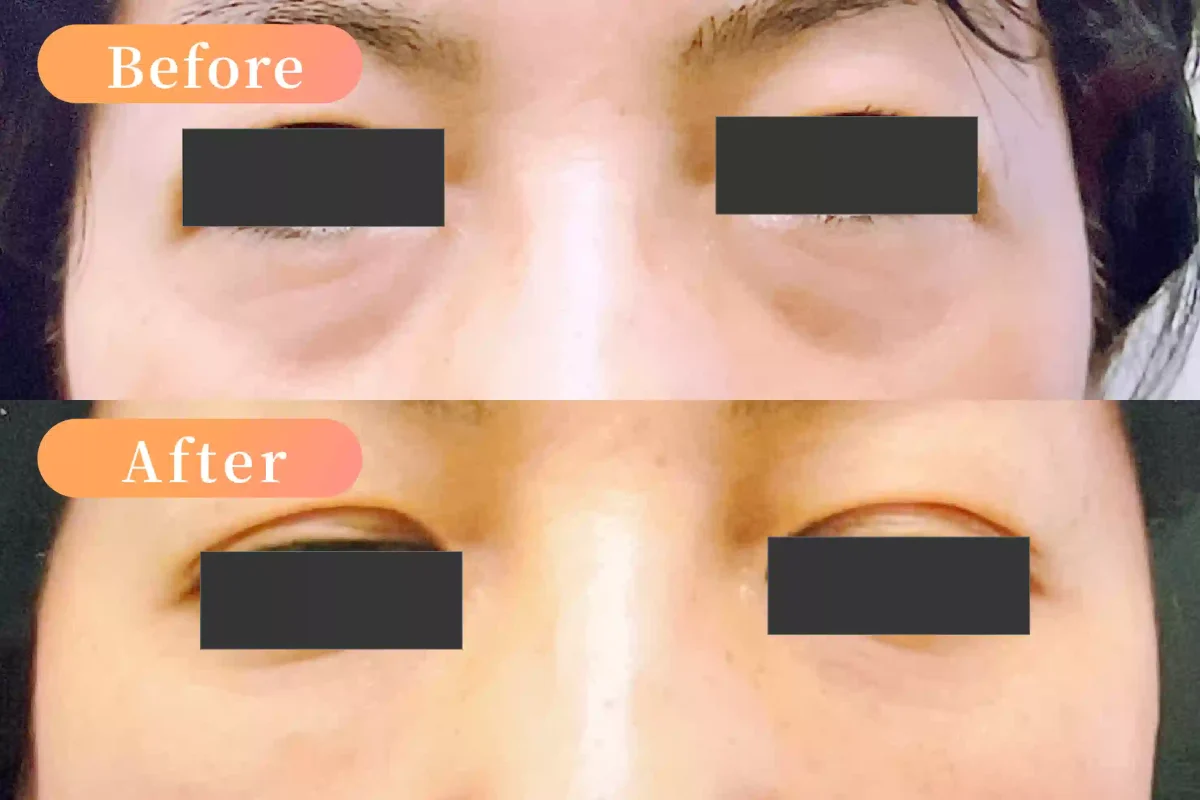 40代　女性　2週間後